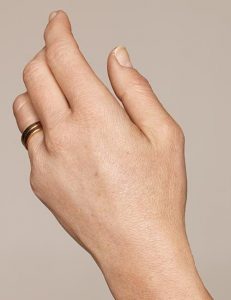 Hände und Dekollete auffrischen mit Restylane Skinbooster